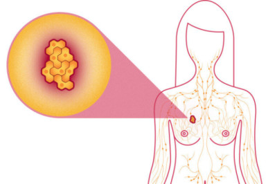 Breast Cancer: Understanding the Causes and Recognizing the Symptoms Early